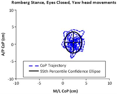 Functional Brain Activation in Response to a Clinical Vestibular Test Correlates with Balance